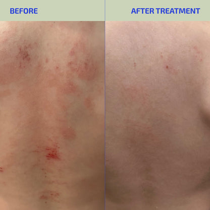BIA ClearSkin Synbiotic Supplement for Eczema-Prone Skin